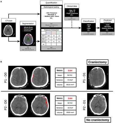 Contribution of CT-Scan Analysis by Artificial Intelligence to the Clinical Care of TBI Patients